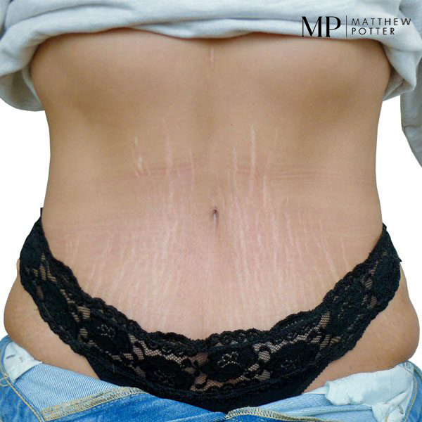 this-photograph-to-replace-the-post-op-on-the-fourth-abdominoplasty-case-please-